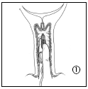 Propess Ferring Lægemidler A/S vaginalindlæg 10 mg