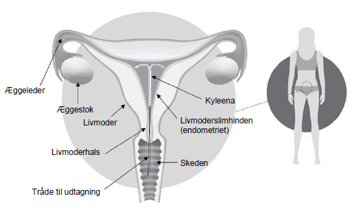 Kyleena intrauterint indlæg 19,5 mg Abacus Medicine A/S