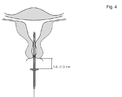 Kyleena intrauterint indlæg 19,5 mg Bayer AB