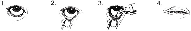 Ganfort 0,3+5 mg/ml øjendråber, opløsning