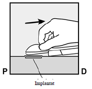 Nexplanon Orifarm A/S implantat 68 mg