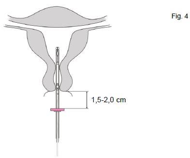 Jaydess Bayer AB, intrauterint indlæg 13,5 mg