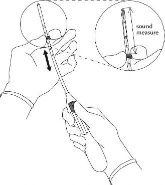 Mirena Abacus Medicine A/S intrauterint indlæg 20 mikrog./24 timer