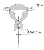 Kyleena intrauterint indlæg 19,5 mg 2care4 ApS