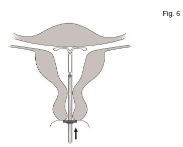 Mirena® Bayer AB, intrauterint indlæg 20 mikrog./24 timer