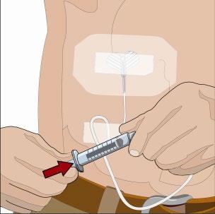 HyQvia Baxalta Innovations GmbH infusionsvæske, opløsning 100 mg/ml