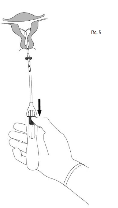 Mirena 2care4 ApS intrauterint indlæg 20 mikrog./24 timer 20 mikrog./24 timer intrauterint indlæg