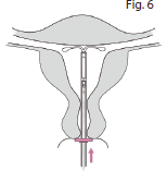 Jaydess Paranova Danmark A/S intrauterint indlæg 13,5 mg 13,5 mg intrauterint indlæg