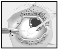 Ozurdex Allergan Pharmaceuticals Ireland intravitreal implantat i applikator 700 mikrogram