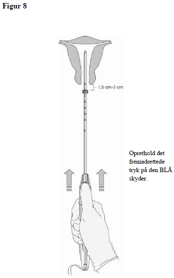 Levosert One Gedeon Richter Plc. intrauterint indlæg 20 mikrogram/24 timer