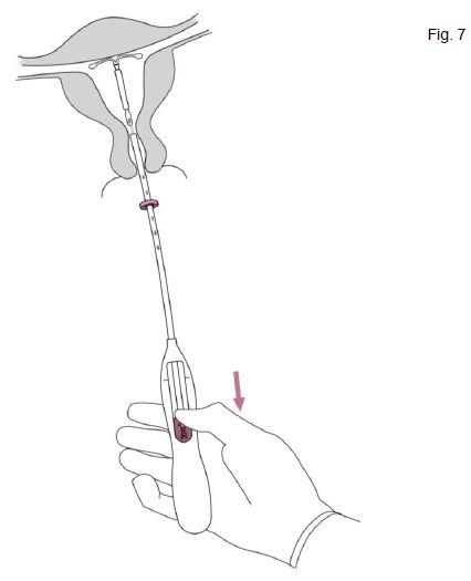 Jaydess Bayer AB, intrauterint indlæg 13,5 mg