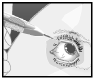 Ozurdex Allergan Pharmaceuticals Ireland intravitreal implantat i applikator 700 mikrogram
