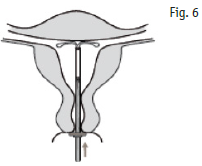 Kyleena 2care4 ApS intrauterint indlæg 19,5 mg