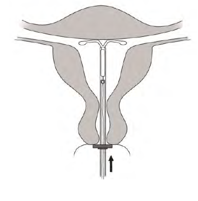 Mirena Abacus Medicine A/S intrauterint indlæg 20 mikrog./24 timer