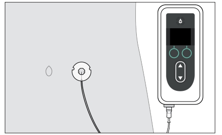 Duodopa AbbVie A/S infusionsvæske, opløsning 240+12 mg/ml