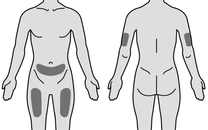 Mircera® injektionsvæske, opløsning i fyldt injektionssprøjte 30 mikrogram/0,3 ml, 50 mikrogram/0,3 ml, 75 mikrogram/0,3 ml, 100 mikrogram/0,3 ml og 150 mikrogram/0,3 ml Roche Registration GmbH