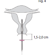 Jaydess Paranova Danmark A/S intrauterint indlæg 13,5 mg 13,5 mg intrauterint indlæg