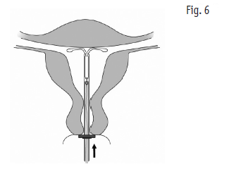Mirena 2care4 ApS intrauterint indlæg 20 mikrog./24 timer 20 mikrog./24 timer intrauterint indlæg