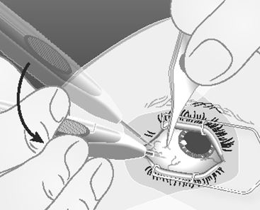 Ozurdex intravitreal implantat i applikator 700 mikrogram AbbVie Deutschland GmbH &amp; Co. KG