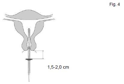 Mirena® Bayer AB, intrauterint indlæg 20 mikrog./24 timer