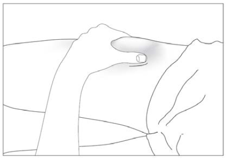 Accofil Accord Healthcare S.L.U. injektions-/infusionsvæske, opløsning, fyldt injektionssprøjte 48 ME/0,5ml
