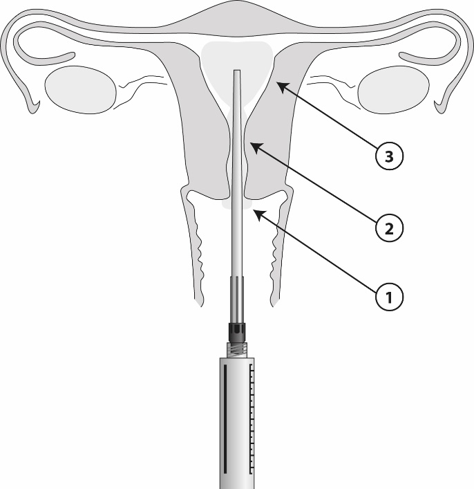 Lidbree Gedeon Richter Plc. intrauterin gel 42 mg/ml