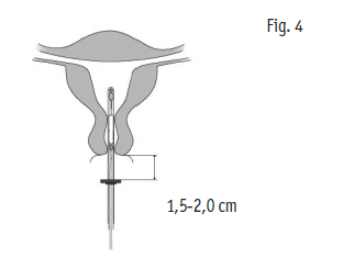 Mirena 2care4 ApS intrauterint indlæg 20 mikrog./24 timer 20 mikrog./24 timer intrauterint indlæg