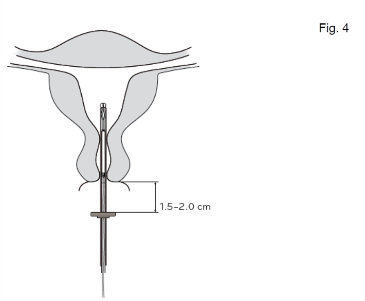 Kyleena Orifarm A/S intrauterint indlæg 19,5 mg