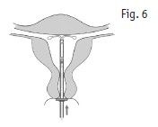 Kyleena intrauterint indlæg 19,5 mg 2care4 ApS