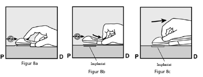 Nexplanon Orifarm A/S implantat 68 mg 68 mg implantat