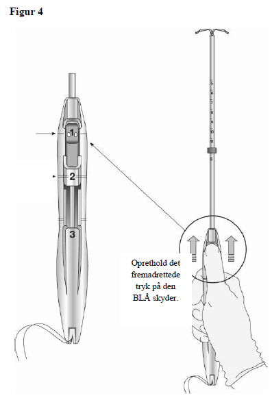 Levosert One Gedeon Richter Plc. intrauterint indlæg 20 mikrogram/24 timer