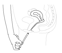 Rewellfem Gedeon Richter Plc. vaginaltabletter 10 mikrogram
