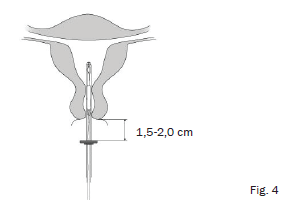 Mirena® intrauterint indlæg 20 mikrog./24 timer Paranova Danmark A/S