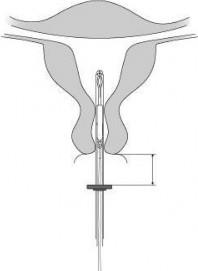 Mirena Abacus Medicine A/S intrauterint indlæg 20 mikrog./24 timer
