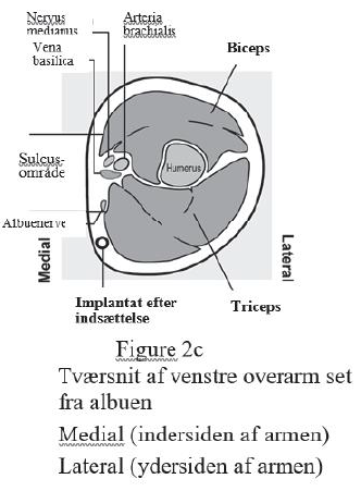 Nexplanon Orifarm A/S implantat 68 mg