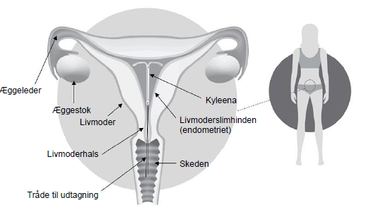 Kyleena intrauterint indlæg 19,5 mg Bayer AB